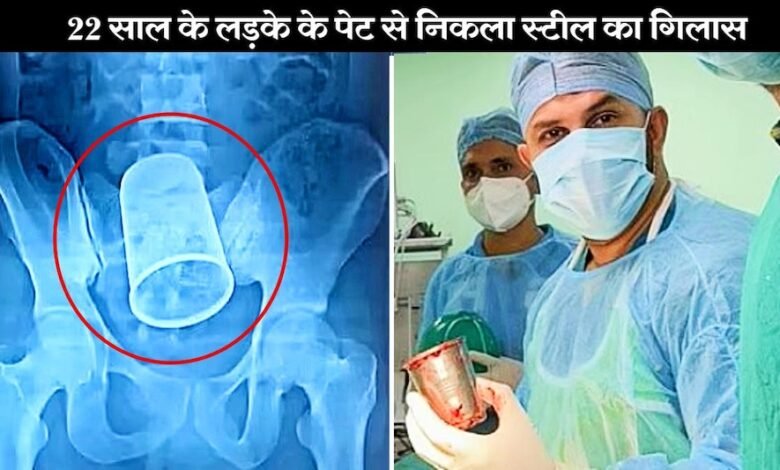 घंटों चली सर्जरी और मरीज के पेट से निकला स्टील गिलास, डॉक्टर भी हैरान, जाने कैसे हुई ये रहस्यमयी घटना
