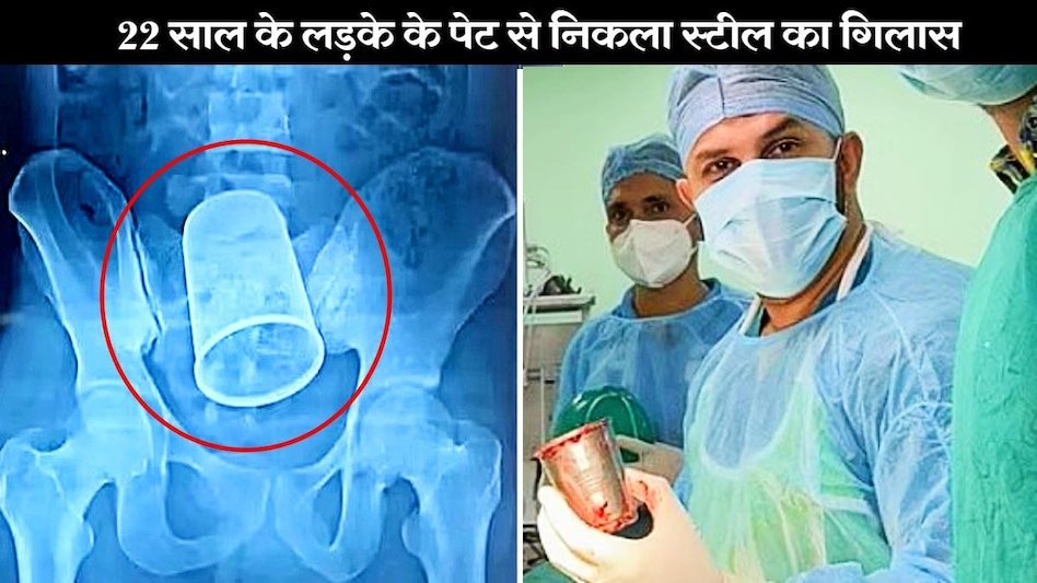 घंटों चली सर्जरी और मरीज के पेट से निकला स्टील गिलास, डॉक्टर भी हैरान, जाने कैसे हुई ये रहस्यमयी घटना घंटों चली सर्जरी और मरीज के पेट से निकला स्टील गिलास, डॉक्टर भी हैरान, जाने कैसे हुई ये रहस्यमयी घटना